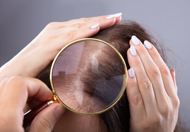 Drożdżaki na głowie – jakie choroby powodują Malassezia furfur?
