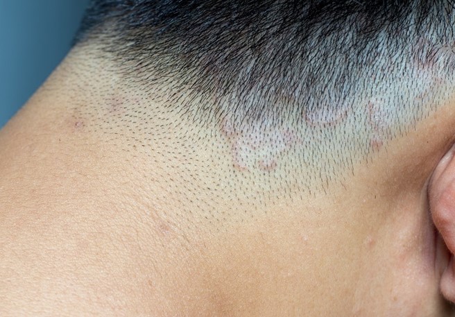 Dermatite Seborroica del cuoio capelluto