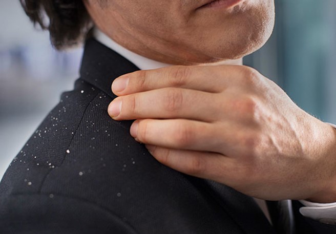 Dandruff & Stress - Tips For Stress Management