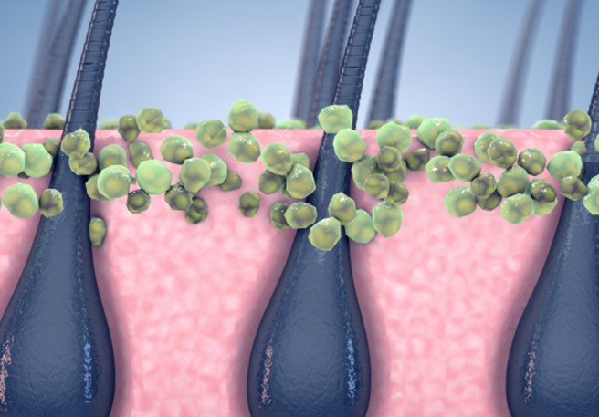 What is Malassezia and how is it related to dandruff?