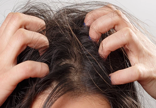 What is Causing My Itchy Scalp?